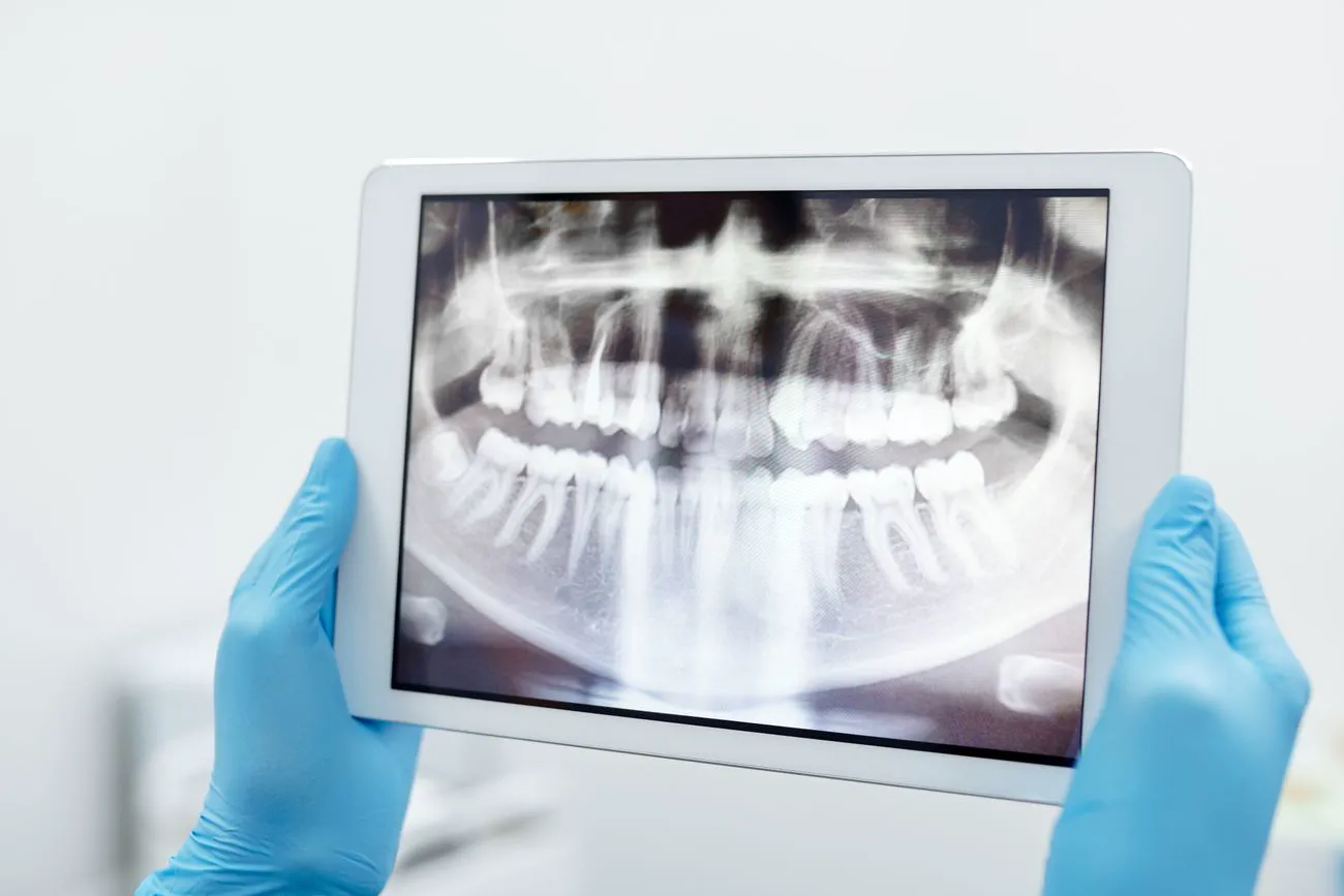 A digital dental X-ray shown on a tablet