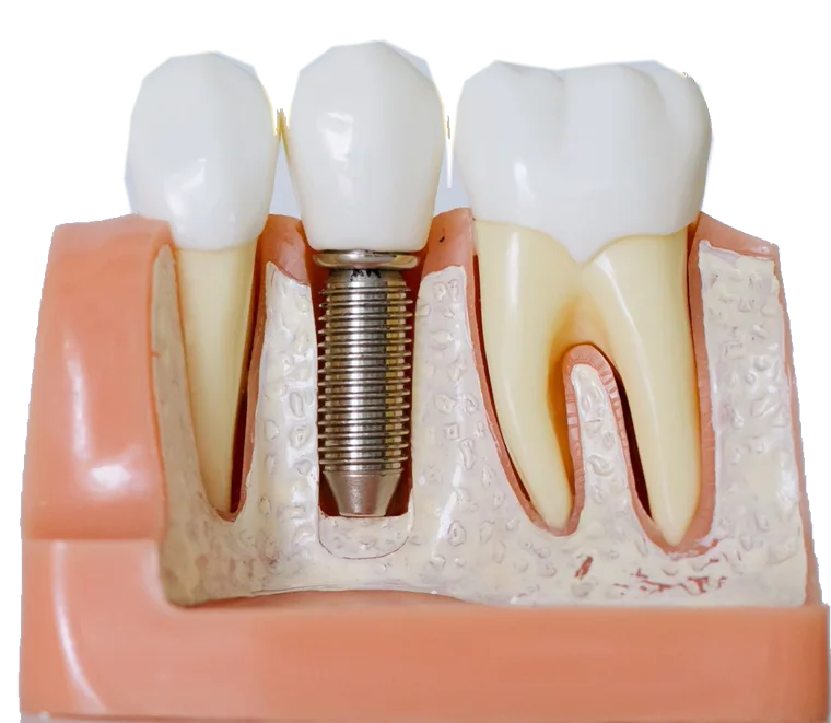 A dental model showing three teeth and an implant